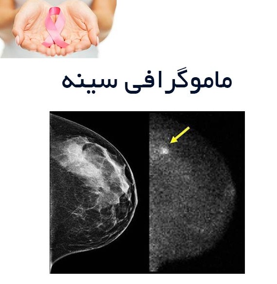 ماموگرافی سینه + بیماری سرطان سینه + BCPI