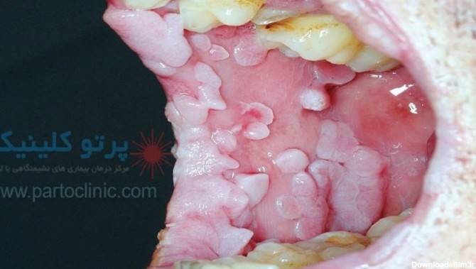 عکس از زگیل تناسلی در دهان