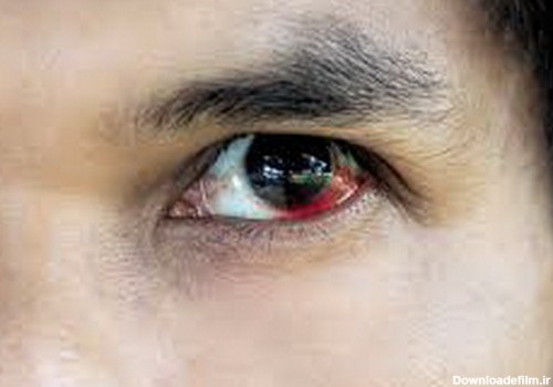خونریزی چشم از علل تا گزینه های درمان | پزشکت