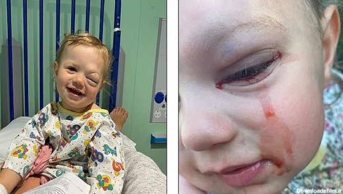 عارضه عجیبی که باعث خون گریه کردن کودک ۲ ساله می‌شود+تصاویر