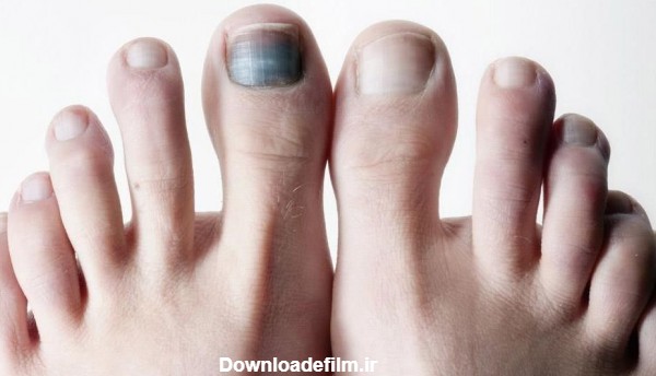 علت سیاه شدن انگشت پای دیابتی - ویرگول