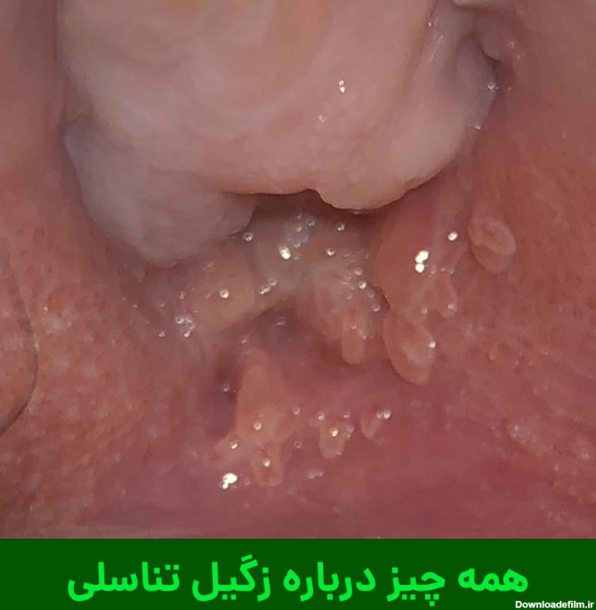 عکس زگیل تناسلی در زنان و مردان