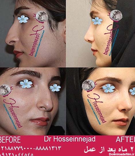 صفر تا صد عمل بینی+(هزینه) | دکتر حسین نژاد