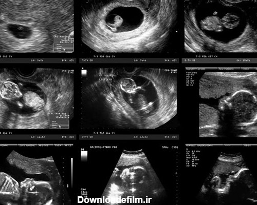 روند رشد جنین در سه ماهه اول بارداری - سونوگرافی و رادیولوژی صدرا