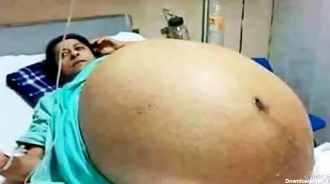 عکس جنین سه قلو در شکم مادر