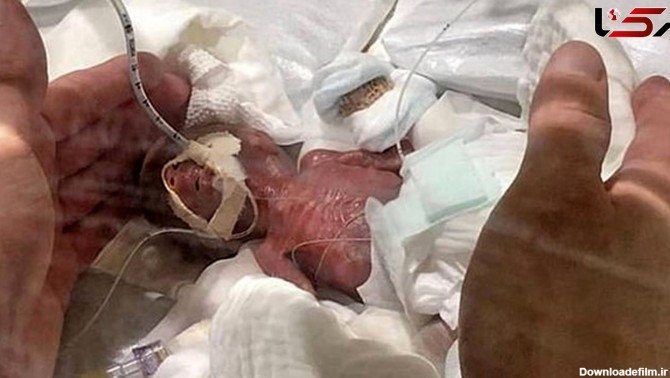 عجیب ترین عکس از تولد کوچکترین نوزاد جهان