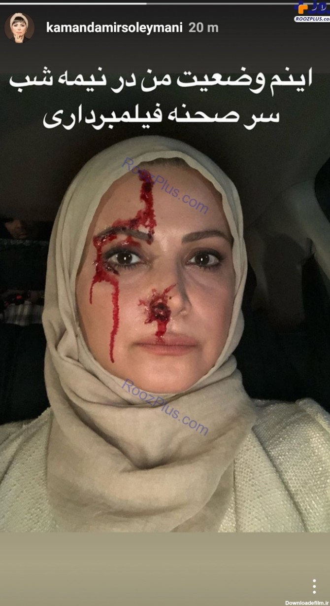 خانم بازیگر با صورت زخمی و خونی +عکس | اقتصاد24