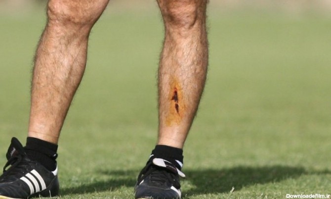 راز زخم عمیق روی ساق پای ساپینتو (عکس)