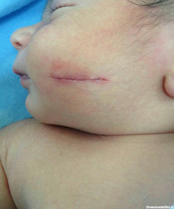 واکنش وزارت بهداشت در مورد زخمی شدن صورت نوزاد +عکس - مشرق نیوز