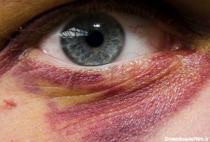 سیاهی و کبودی چشم چیست و چرا بعد از ضربه ایجاد می‌شود؟ + رااه درمان