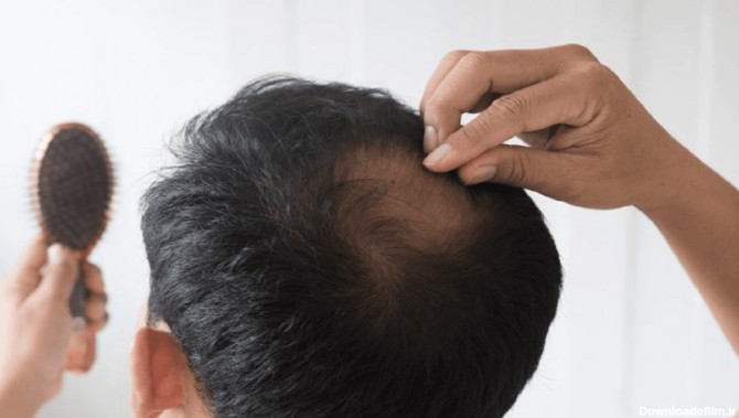 انواع ریزش مو، علائم، روش های کنترل و درمان | باریج اسانس