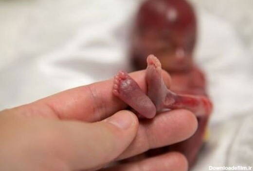 تصویر دردناک سقط جنین هفت هفته ای خارج از رحم
