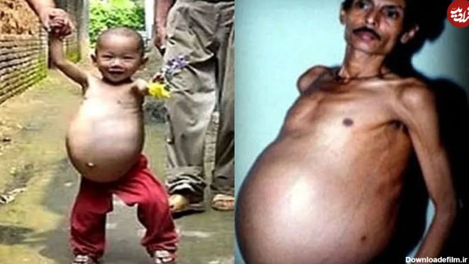 عکس) مرد هندی ۳۶ سال از بارداری اش بی خبر بود!