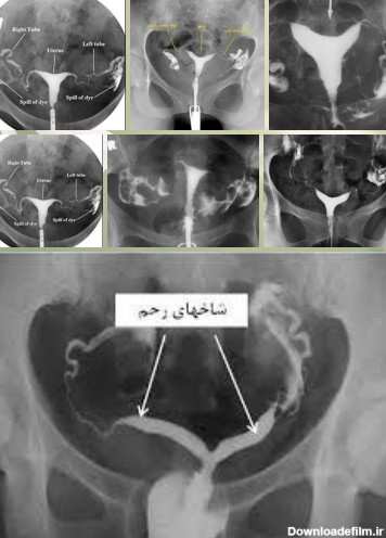 عکس رنگی رحم HSG | تصویربرداری پزشکی بیمارستان آرمان خیابان سئول