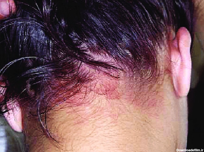فرارو | شپش موی سر؛ انواع نشانه‌ ها و راه‌ های درمان شپش سر