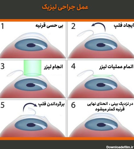 جراحی لیزیک چشم، کارایی، مزایا و معایب (بخش اول) - کلینیک چشم ...