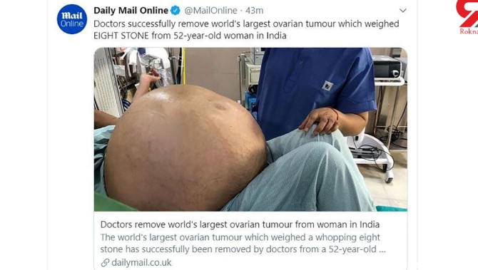 خارج کردن بزرگترین و باورنکردنی‌ترین تومور تخمدان از شکم یک زن + ...