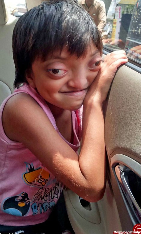 بیماری نادر یک دختر بچه (+عکس)