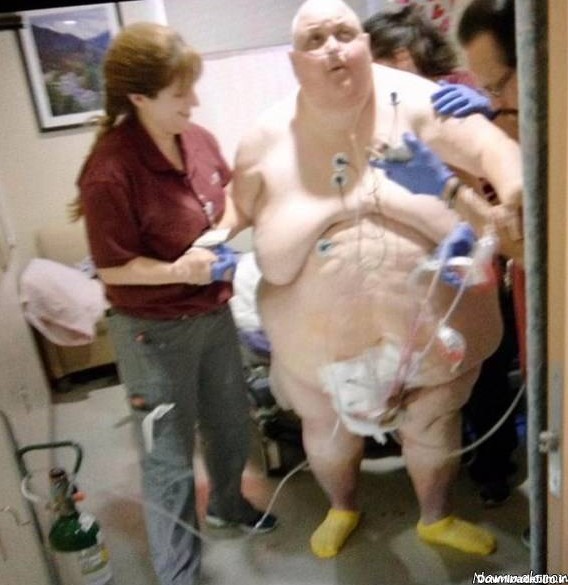 تورمور شکمی , جراحی بزرگترین تومور دنیا بعد از12 سال