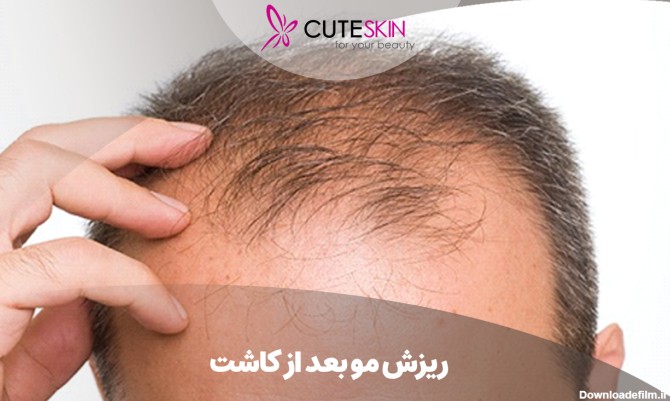 ریزش مو بعد از کاشت؛ علائم، دلایل و روش پیشگیری - کیوت مگ | CuteSkin