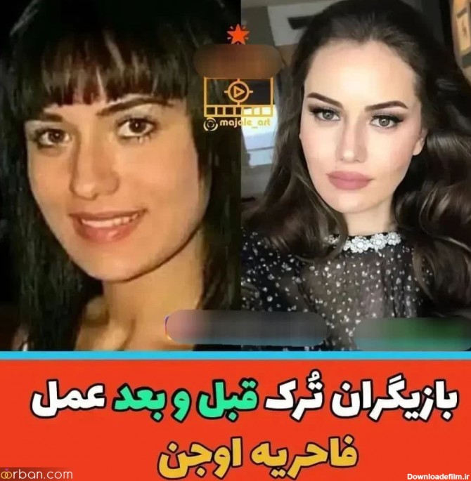 چهره بازیگران مطرح ترکیه ای قبل و بعد از عمل های متعدد (+عکس ...