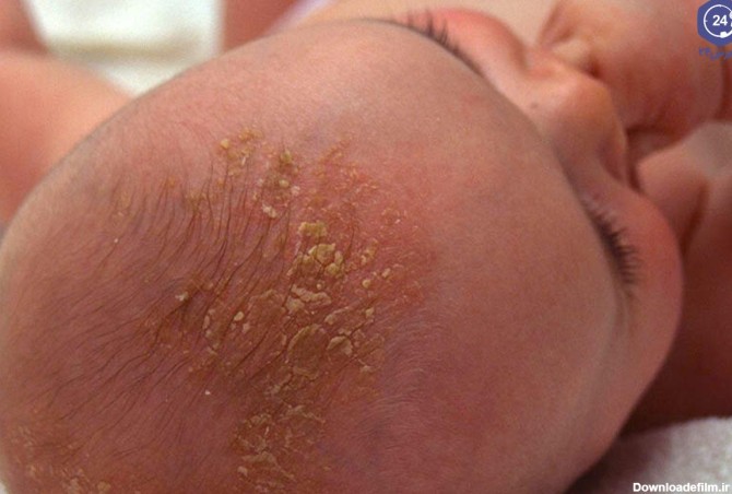 علت پوست ریزی سر نوزاد چیست؟ درمان پوسته شدن سر نوزادان | پذیرش۲۴