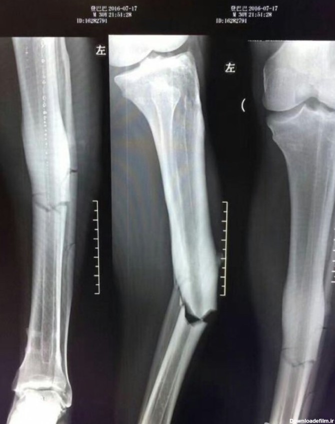 عکس رادیولوژی شکستگی پای خدابیامرز دمبا با+عکس | طرفداری