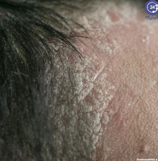 علت پوسته پوسته شدن پوست سر و روش‌های تشخیص و درمان آن | پذیرش۲۴