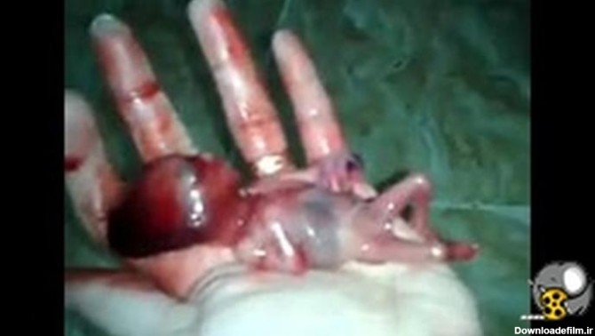 فیلمی از جنین تازه سقط شده - فیلو