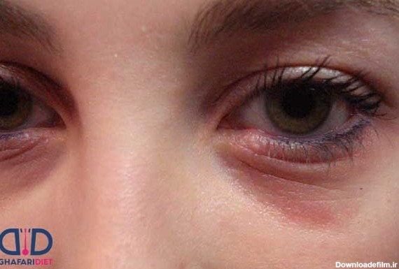 عکس کبودی چشم