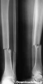 درمان شکستگی استخوان های نازک نی ساق پا – دكتر ورياني متخصص ارتوپد ...