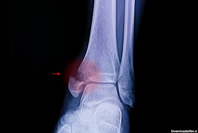 شکستگی قوزک داخلی مچ پا، شرح علائم و نحوه درمان | دکتر فرید ...