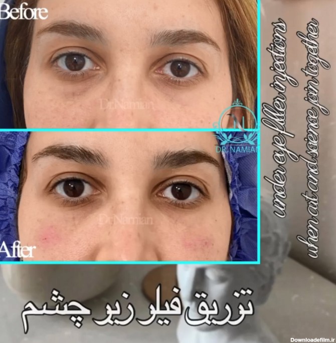 تزریق ژل زیر چشم نمونه کار شماره 36 برای رفع گودی زیر چشم