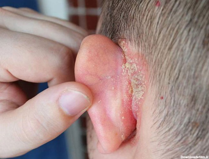 انواع آلرژی‌ها می‌توانند به پوسته‌پوسته شدن گوش منجر شوند.