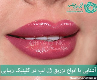 انواع ژل لب در کلینیک جهانشهر کرج، ژل روسی، طبیعی، عروسکی در کرج