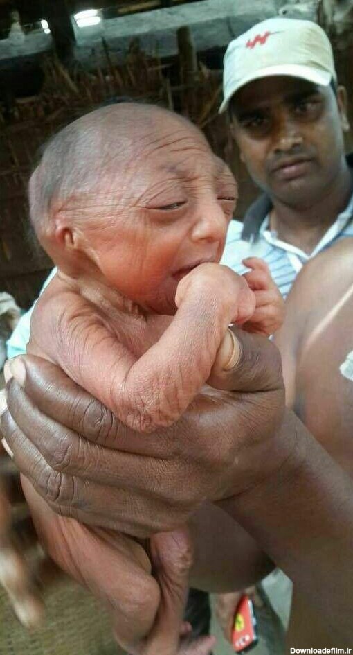 تولد عجیب ترین نوزاد جهان | شباهت کودک به پیرمرد 110 ساله! / عکس