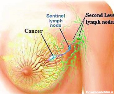 نمونه برداری غده لنفاوی زیر بغل در سرطان پستان | دکتر بهزاد رحمانی