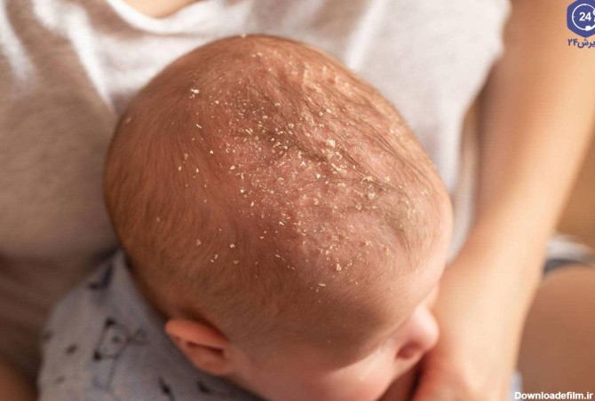 جلوگیری از پوست ریزی سر نوزاد