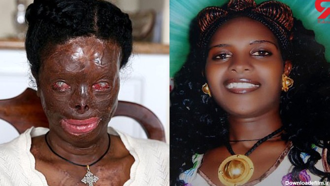 عکس چهره قبل و بعد از اسیدپاشی یک زن ! / او فقط طلاق خواست ...