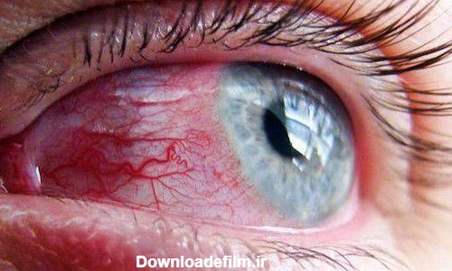 درمان التهاب چشم