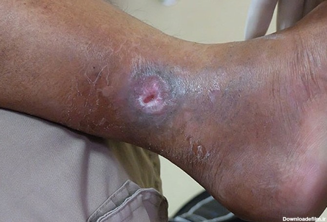درمان زخم پای وریدی