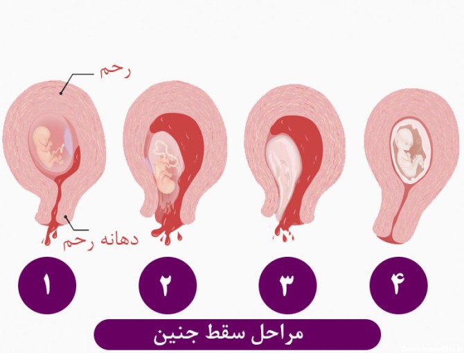 مراحل سقط جنین