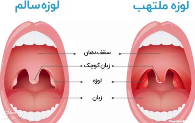 عکس لوزه سالم کودک