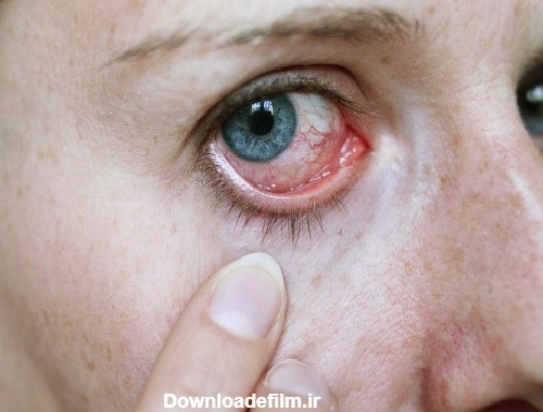 روش های پیشگیری و درمان حساسیت چشم
