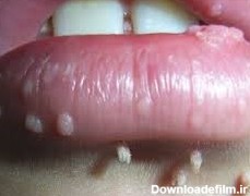 زگیل دهانی - تناسلی وروكوولگاريس | راه های پیشگیری و درمان زگیل دهانی