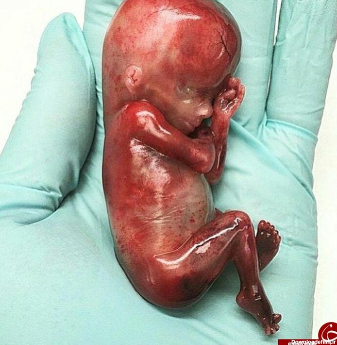تولد جنین سقط شده 19 هفته ای +عکس
