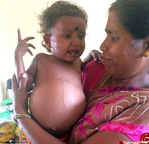 نوزاد دختر هنگام تولد، دوقلو باردار بود! (+عکس)
