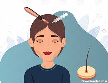 مزونیدلینگ مو چیست و چه تاثیری در درمان ریزش مو دارد ...