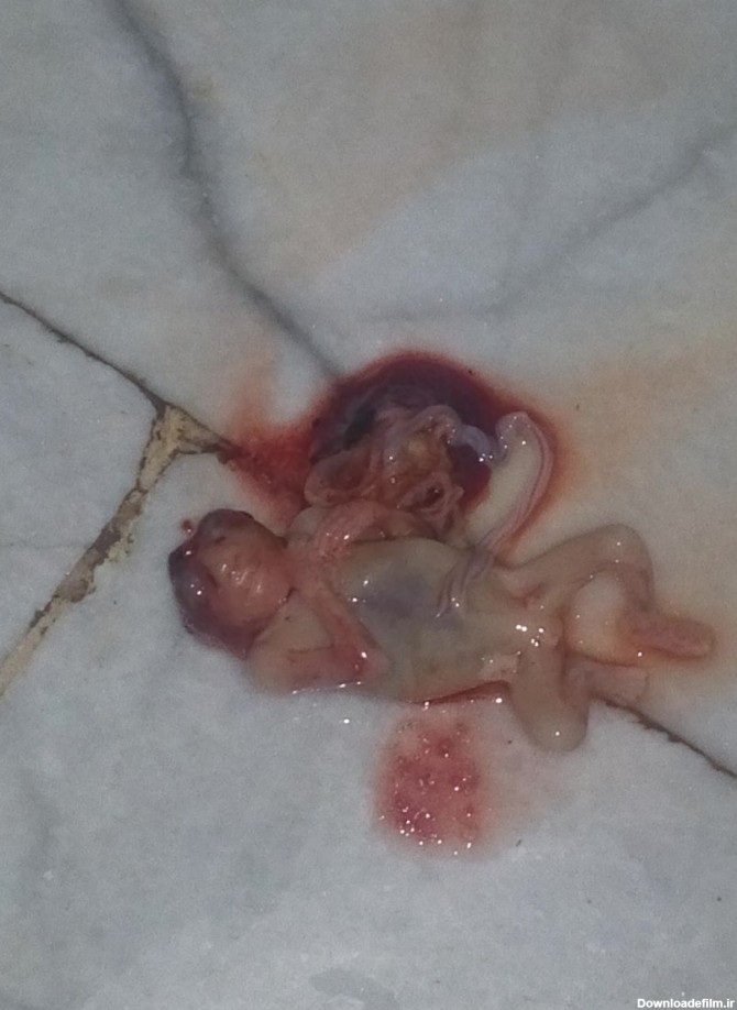 عکس جنین سقط شده سه ماهه
