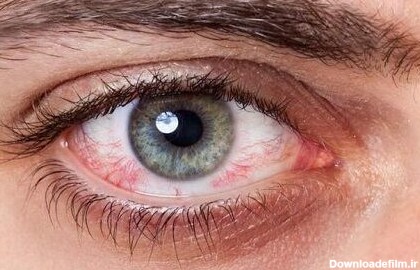 قرمزی چشم‌ها چه زمانی خطرناک است؟ - www.oipf.ir